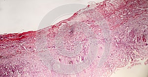 Tuberculous pleurisy, light micrograph