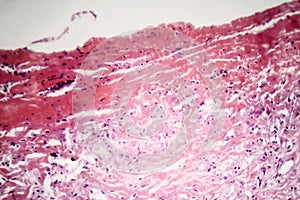 Tuberculous pleurisy, light micrograph