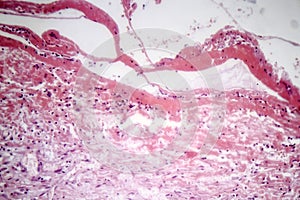 Tuberculous pleurisy, light micrograph