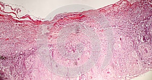 Tuberculous pleurisy, light micrograph