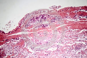 Tuberculous pleurisy, light micrograph