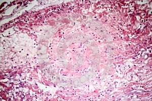 Tuberculous pleurisy, light micrograph