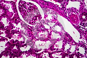 Tubular atrophy, light micrograph