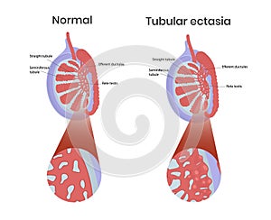 Tubular ectasia of rete testis with normal testicular anatomy photo