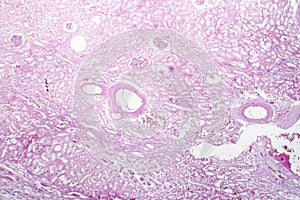 Tubular epithelial edema