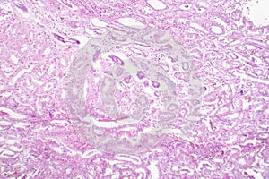 Tubular epithelial edema