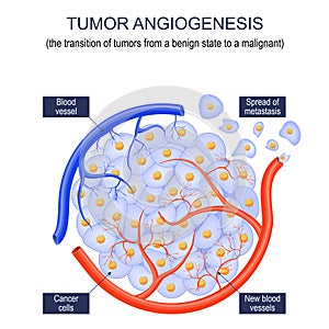 Tumor angiogenesis photo