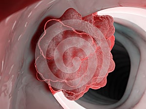 a tumor in the colon