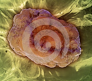 Tumor formation photo