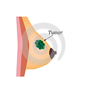 Tumor in the mammary gland. World Breast Cancer Day. Vector illustration on isolated background