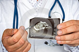 Tumor or other oncology in kidney on ultrasound image concept photo. Doctor indicating by pointer on printed picture ultrasound pa photo