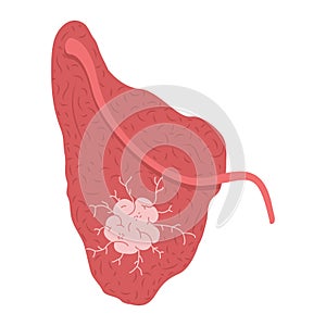 A tumor on the parotid salivary gland. photo