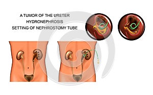 A tumor of the ureter. hydronephrosis. setting of nephrostomy tube