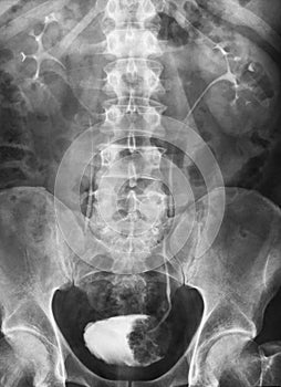 Tumor in the urinary bladder