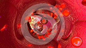 Tumour cells in blood vessels photo
