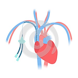 Tunneled central line venous catheter medical diagram