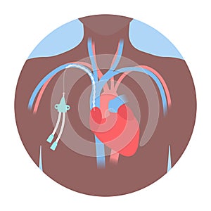 Tunneled central line venous catheter medical diagram