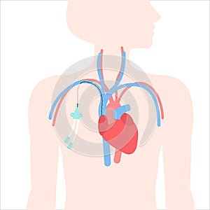 Tunneled central line venous catheter medical diagram