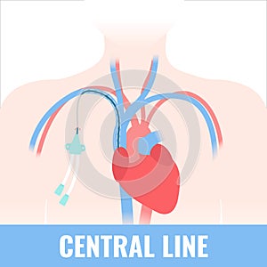 Tunneled central line venous catheter medical diagram