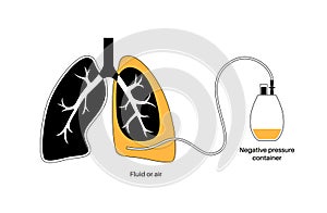 Tunneled pleural catheter