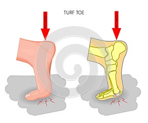 Turf toe. Rupture of the plantar plate of the first toe of the f