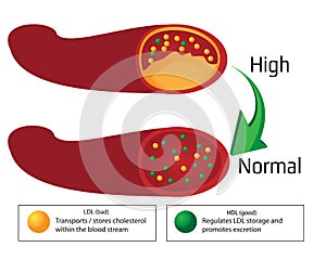 Turning high level of atherosclerotic plaque in blood vessel into normal level