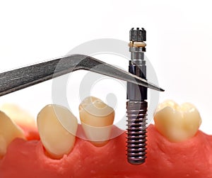 Tweezers with dental implant