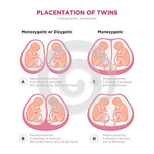 Twin types infographic elements in flat design. Monozygotic or Dizygotic Placentation of twins medical illustration and