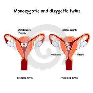 Twins in uterus. Monozygotic and Dizygotic