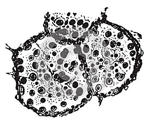 Two alveoli and a part of third from lung in catarrhal pneumonia, vintage engraving