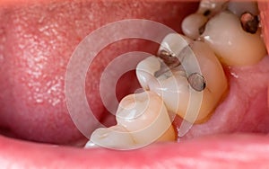 Two back molars with metal fillings photo