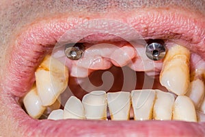 Two canine dental implants in the mouth of a patient with advanced periodontitis