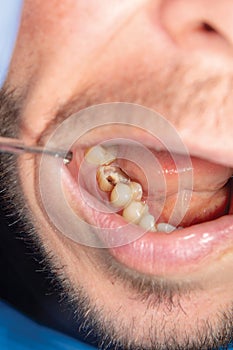 two chewing side teeth of the upper jaw after treatment of caries. Restoration of the chewing surface with a photopolymer filling