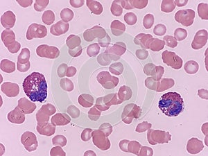 Two eosinophils seen on peripheral blood smear
