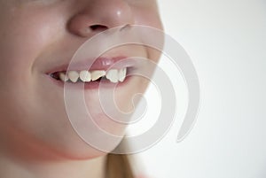 Two front female teeth are broken. The girl fell and knocked out her teeth photo