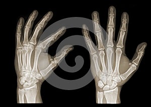 Two hands on x-ray