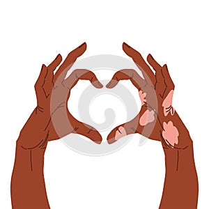 Two hands showing heart shape, one hand with vitiligo patch