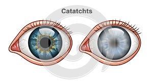 Illustration of cataracts affecting the eye photo