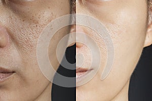 Two pictures compare effect Before and After treatment. skin with problems of freckles , pore , dull skin and wrinkles