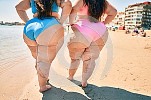 Two plus size overweight women showing legs vascular disease of varicose and thrombosis at the beach