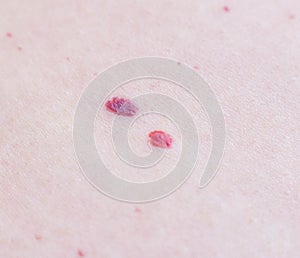 Two red moles on the patient s skin, hemangioma, macro, angioneuromas