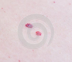 Two red moles on the patient s skin, hemangioma, macro, angioneuromas photo