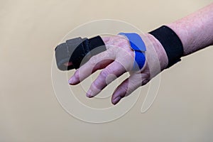 two sided finger splint with two hook and loop straps on a broken finger