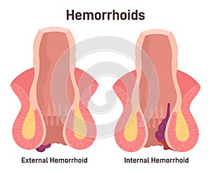 Two types of hemorrhoids. Internal and external hemorrhoidal