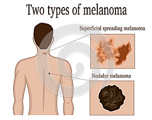 Two types of melanoma photo
