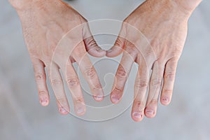 Two young man hands with ugly and bitten fingernails