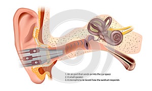Tympanometry. Response Eardrum Testing.
