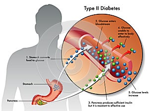 Tipo 2 diabete 