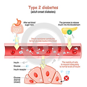 Type 2 diabetes. adult-onset diabetes