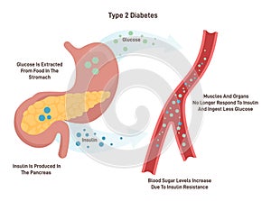 Type 2 diabetes medical vector illustration with english description